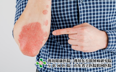 攝圖網_506432486_患有粗俗的牛皮癬濕疹和其他皮膚?。ㄆ髽I商用）