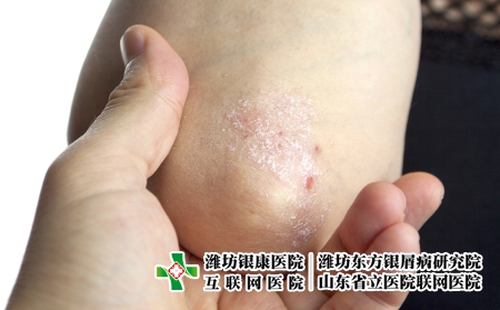 攝圖網_502556199_手肘上的絲蟲(企業商用) 攝圖網_502556199_手肘上的絲蟲(企業商用)