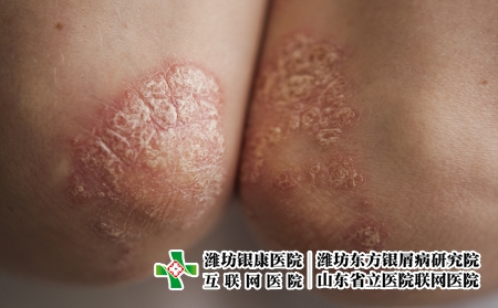 攝圖網_326238053_身穿白色T恤的年輕女子手肘皮膚上的絲蟲病癥狀發癢皮炎疾病衛生保健濕疹皮膚科女性女孩(企業商用) 攝圖網_326238053_身穿白色T恤的年輕女子手肘皮膚上的絲蟲病癥狀發癢皮炎疾病衛生保健濕疹皮膚科女性女孩(企業商用)