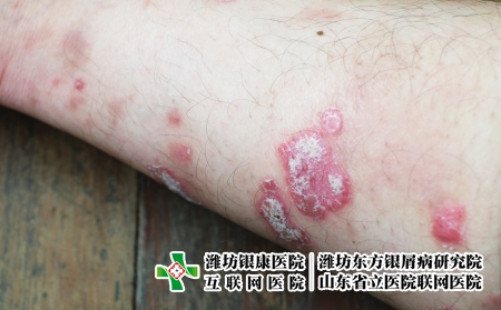 攝圖網(wǎng)_323551459_絲蟲病宏觀藥品疾病彎頭發(fā)癢病人醫(yī)療皮膚手臂皮炎(企業(yè)商用) 攝圖網(wǎng)_323551459_絲蟲病宏觀藥品疾病彎頭發(fā)癢病人醫(yī)療皮膚手臂皮炎(企業(yè)商用)