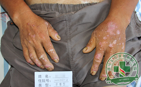 銀屑病預(yù)防