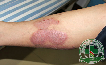 患上銀屑病會不會傳染