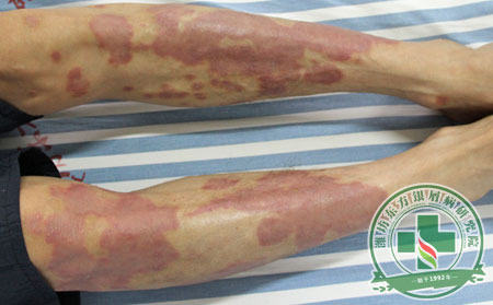 生活中要如何降低銀屑病發病率