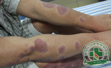 銀屑病需要注意什么