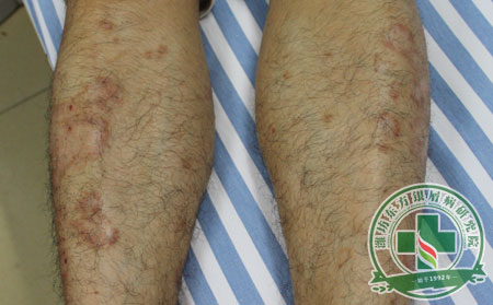 銀屑病傳染人嗎