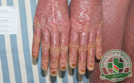 關(guān)節(jié)型銀屑病