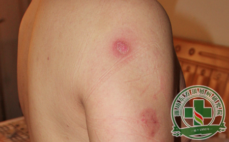 患有膿皰型銀屑病怎么辦