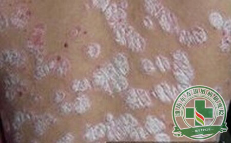 尋常型銀屑病患者怎么正確護(hù)理?