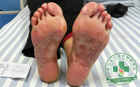 腳部銀屑病患者要怎么保養(yǎng)
