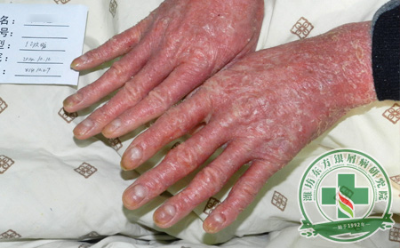 哪些措施可預防關節病性銀屑病