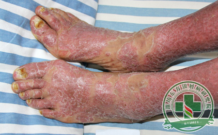 春季的關節病型銀屑病怎樣預防