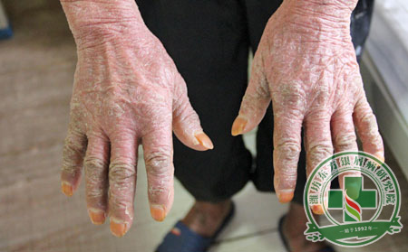 關(guān)節(jié)型銀屑病可分為哪幾個(gè)類型?