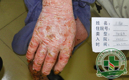 預防女性關節病型銀屑病方法