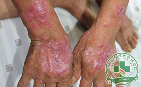 銀屑病預(yù)防