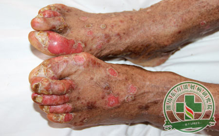 怎么做理想關節型銀屑病預防