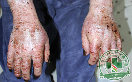 治療關節病型銀屑病理想方法