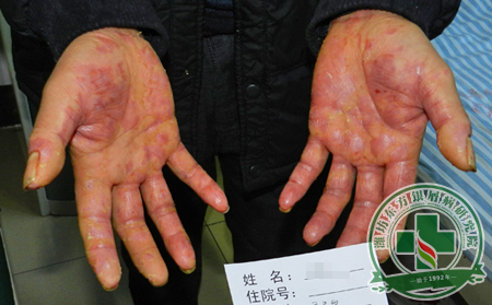 女性銀屑病患者一些美麗要舍棄