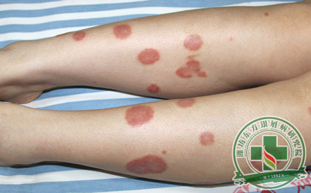 銀屑病預(yù)防