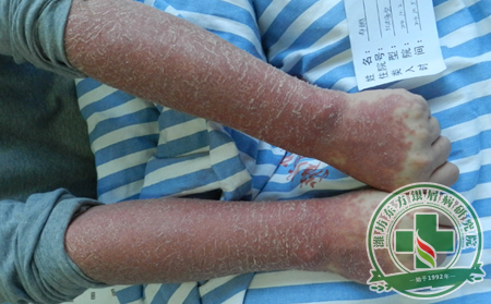 什么樣的女性容易患有銀屑病疾病?