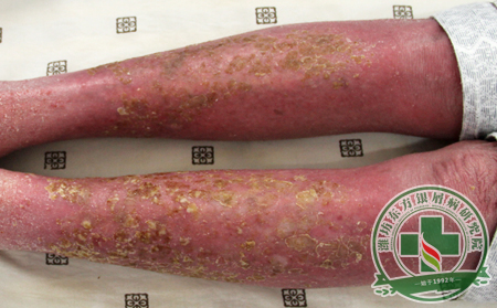 紅皮型銀屑病