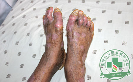 后天里如何預防銀屑病遺傳