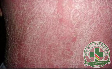 紅皮型銀屑病有什么表現