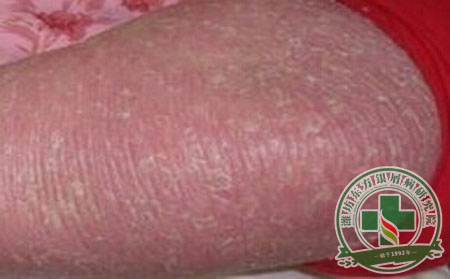 生活中怎樣預防紅皮型銀屑病