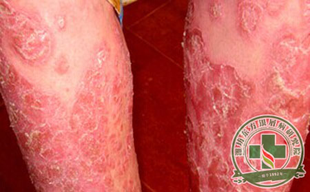 紅皮型銀屑病預防重點