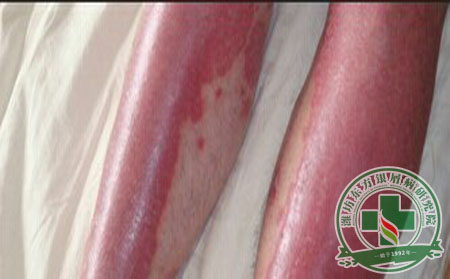 紅皮型銀屑病病因檢查