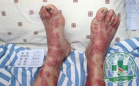 銀屑病注意事項(xiàng)有什么