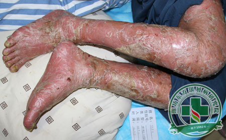 膿皰型銀屑病有哪些危害