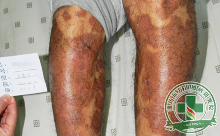 銀屑病的并發癥具體是些什么