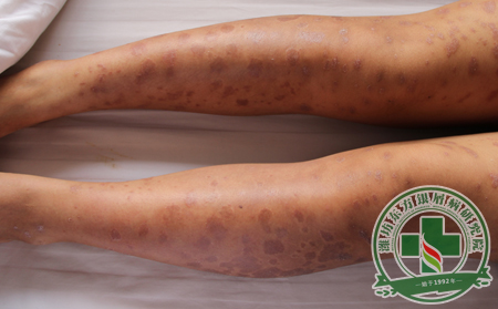 銀屑病的癥狀分類有哪些