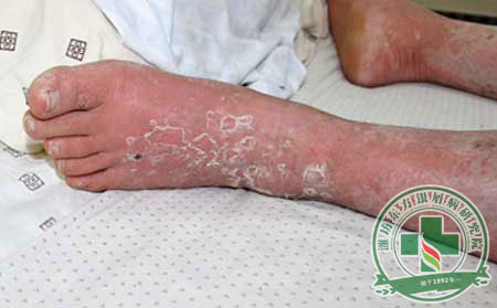 關(guān)節(jié)型銀屑病的臨床癥狀表現(xiàn)