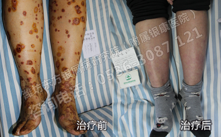 病情穩(wěn)定后