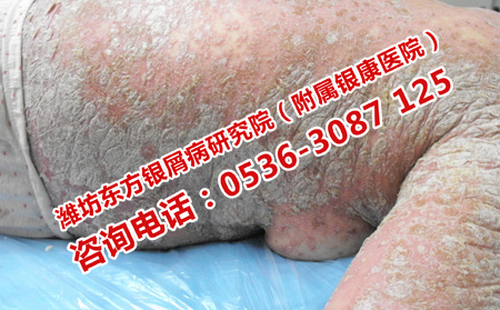 治銀屑病什么方法理想