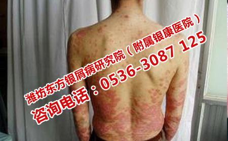 心態對牛皮癬的治療有什么作用