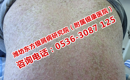 牛皮癬正確的治療方法是什么