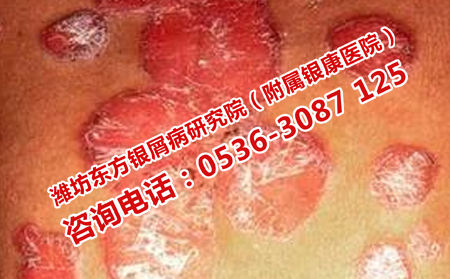 治療牛皮癬什么方法有效