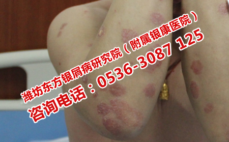 尋常型牛皮癬治不理想的原因