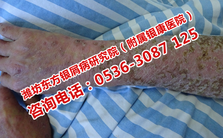 牛皮癬患者怎樣吃