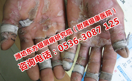 牛皮癬怎么能治理想