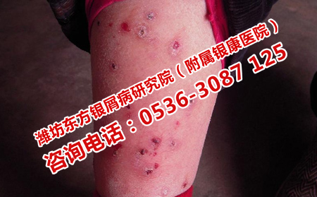 牛皮癬的病因是什么