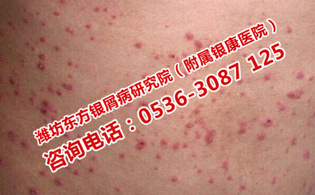 治療牛皮癬實力強的醫院