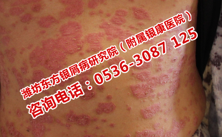 得了牛皮癬應該去哪兒治療