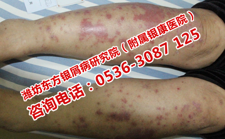 銀屑病到底能治理想嗎