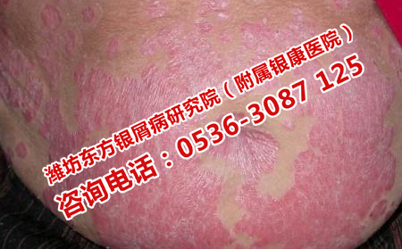 尋常型牛皮癬治療晚了還能恢復(fù)嗎