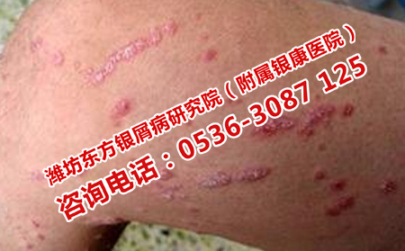 什么方法阻止牛皮癬復發