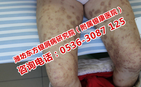 中醫(yī)治療牛皮癬抗復(fù)發(fā)嗎