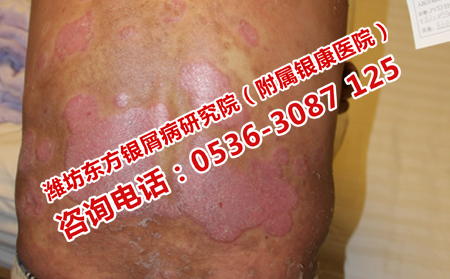 牛皮癬癥狀加重了怎么辦